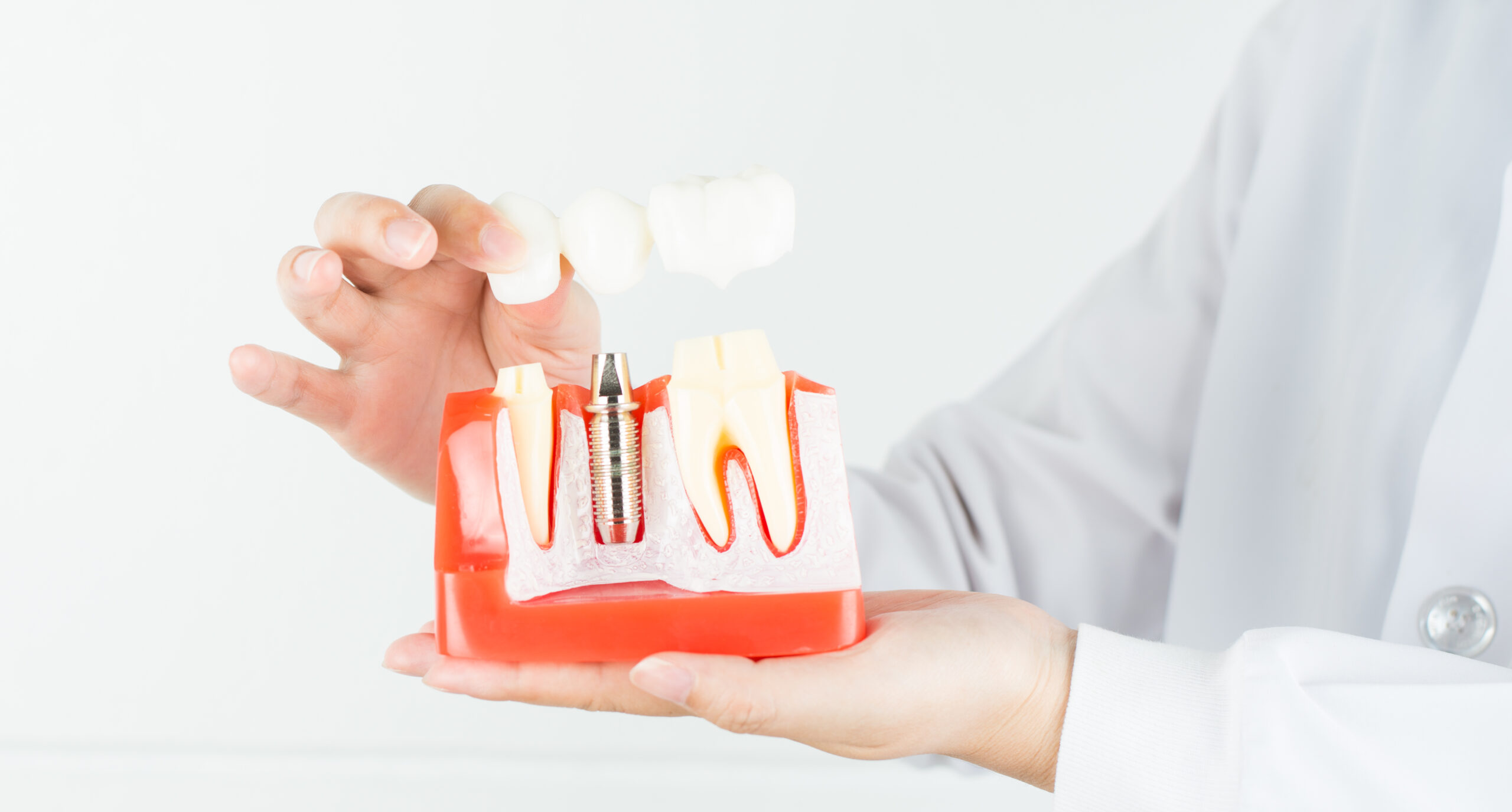 Todo lo que debes saber acerca de los implantes dentales - Clínica dental Dr. Espinosa en GIjón